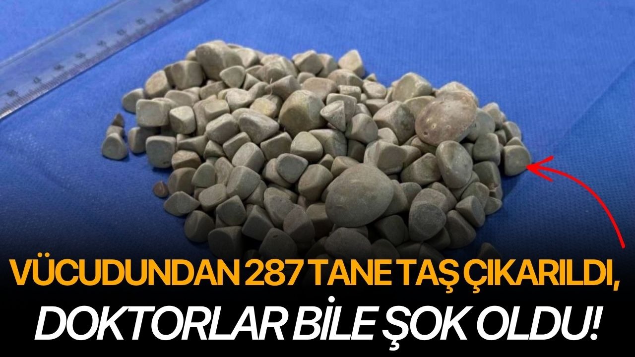 Vücudundan 287 tane taş çıkarıldı, doktorlar bile şok oldu!