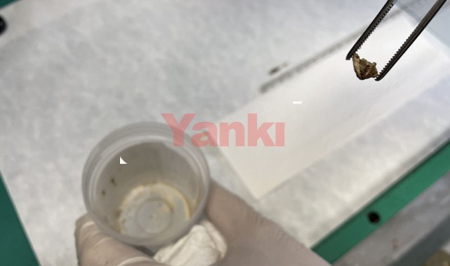 Kanser sandılar, soluk borusundan badem zarı çıktı