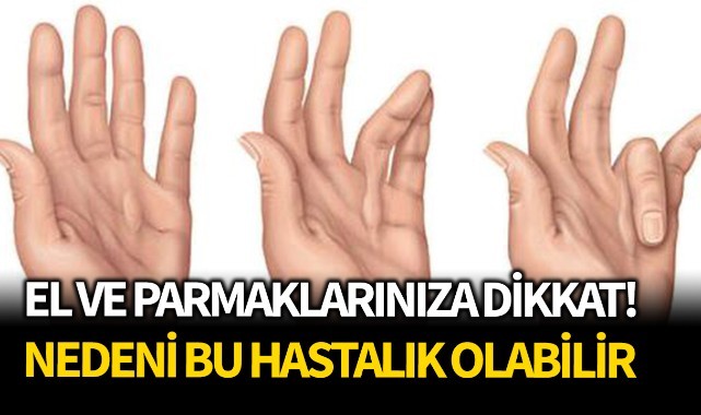 El ve parmaklarınıza dikkat! Nedeni bu hastalık olabilir