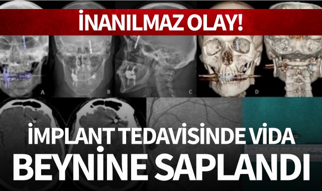 İnanılmaz olay: İmplant tedavisinde vida beynine saplandı