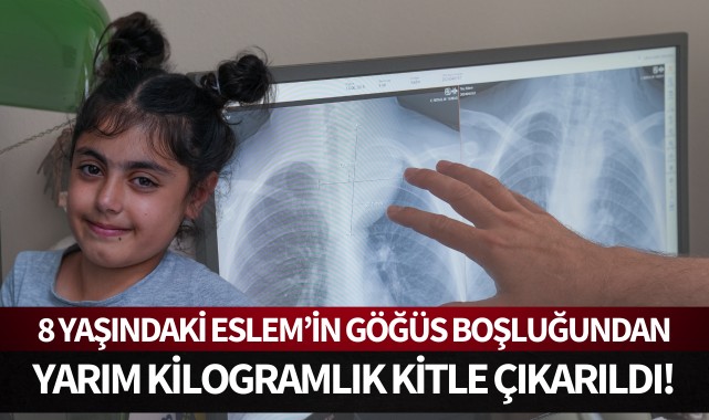 Nefes darlığı çeken çocuğun göğüs boşluğundan çıktı: Yaklaşık yarım kilo!