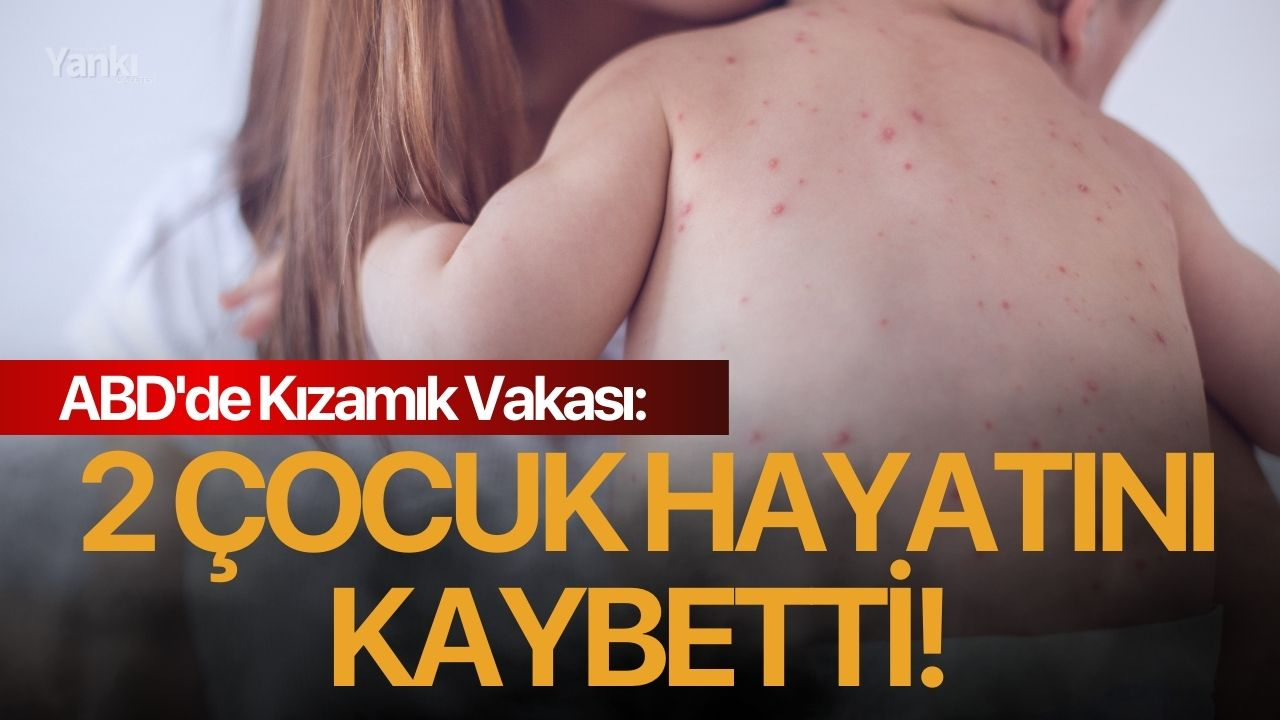 ABD'de Kızamık Vakası: 2 çocuk hayatını kaybetti!