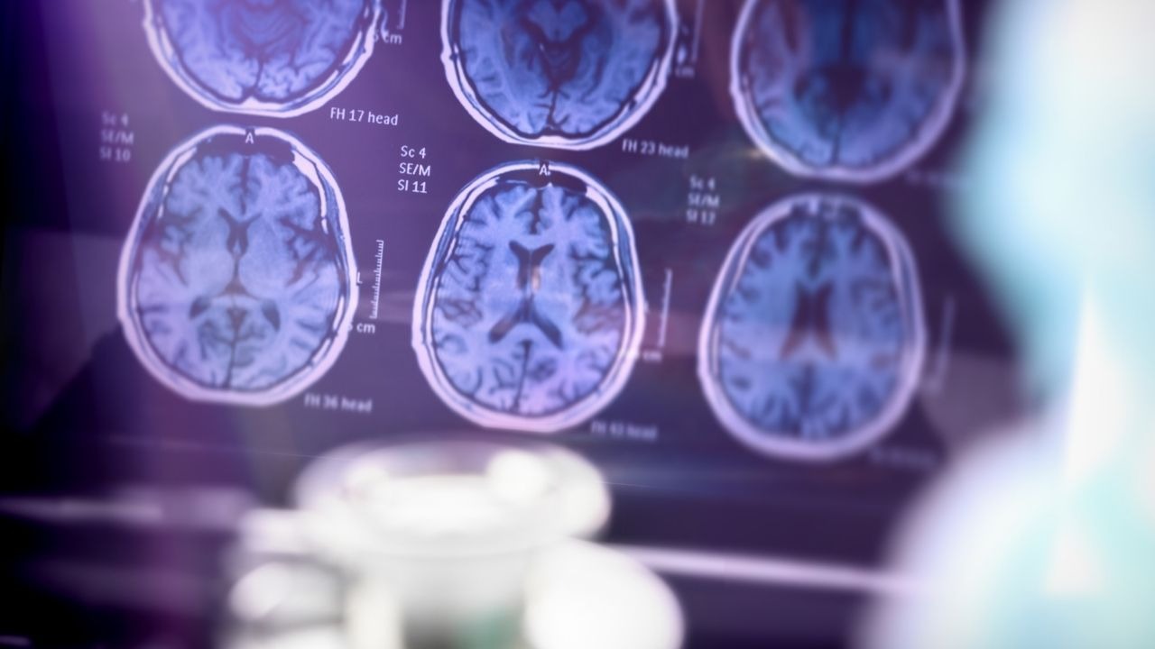 "Alzheimer’da erken tanı ile semptomlar yavaşlatılabilir"